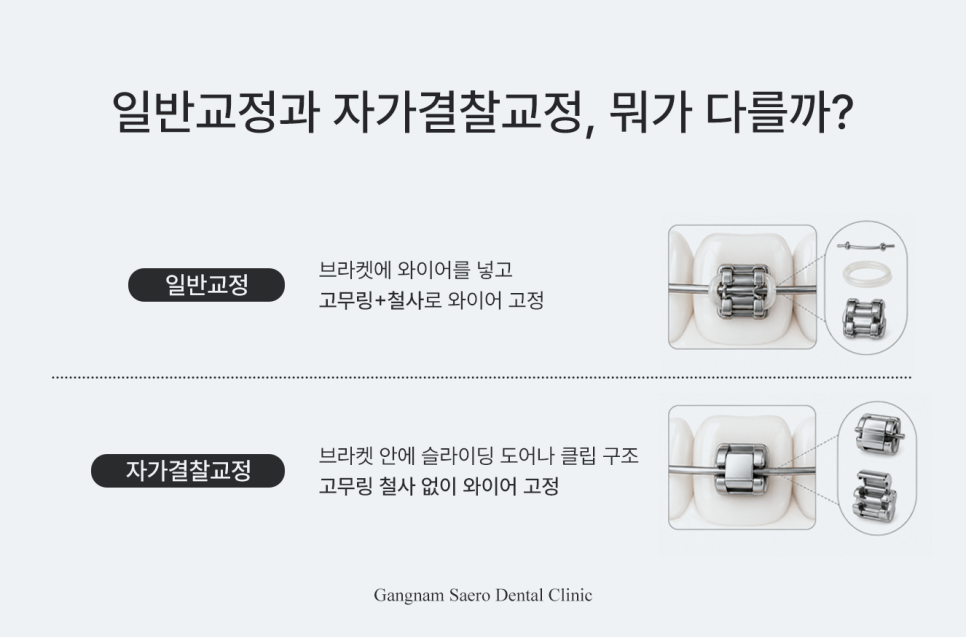 자가결찰교정, 기찻길 일반 교정이 불편하다면 데이몬 / 클리피씨 / 마제스티 / 트리니티 관련 이미지 2