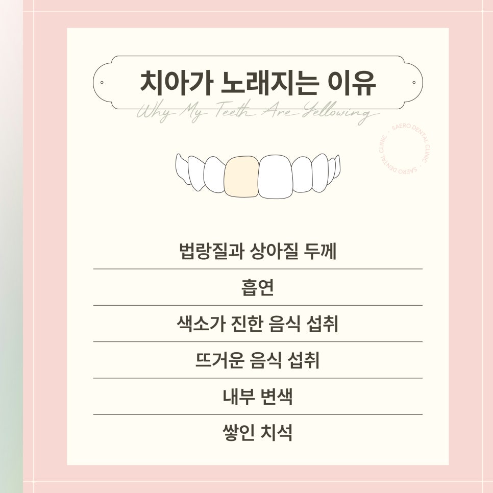 치아 변색 원인에 따른 치아미백효과 (치아미백비용) 관련 이미지 2