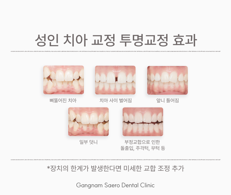 Types of Adult Orthodontic Appliances: A Guide to Choosing Clear Aligners image 4