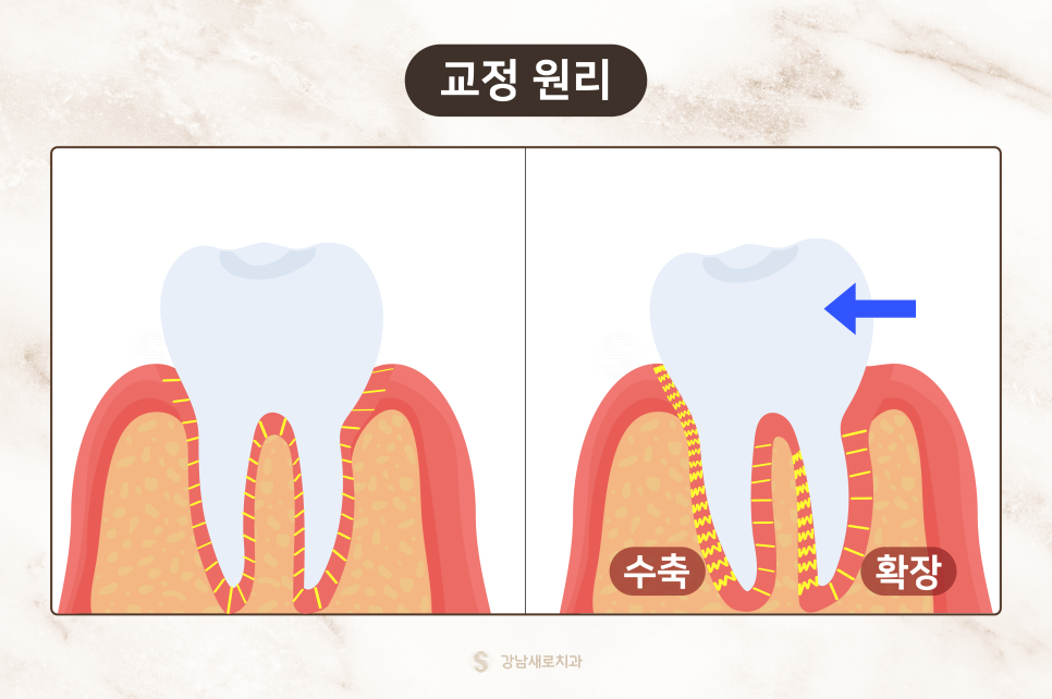 치아교정 자주하는 질문 Q&A (투명교정효과) 관련 이미지 4