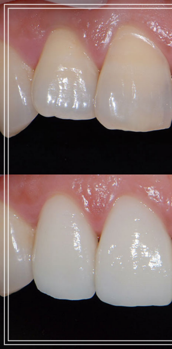 헨리라미네이트, 치아 손상없이 안전하게 진행 관련 이미지 6
