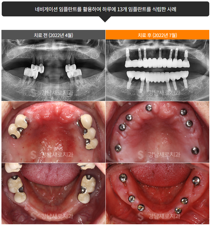 임플란트붓기 출혈 통증 걱정된다면 (네비게이션 임플란트) 관련 이미지 4