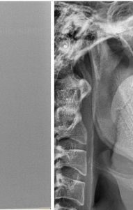 양악전 교정과 양악후 교정, 진행 방법의 차이를 알아보자. 관련 이미지 6