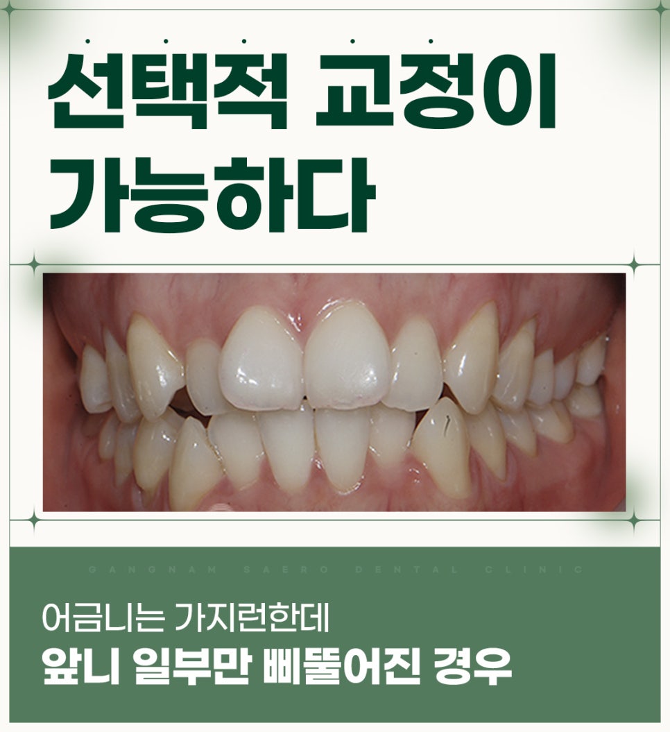 4개월 급속교정 (전체교정은 부담스럽다면 부분교정) [ 강남새로치과 ] 관련 이미지 3