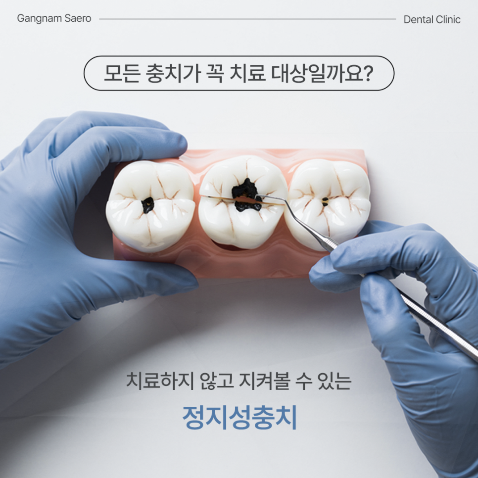 Is There a Cavity That Doesn’t Need Treatment? (Arrested Caries) image 1