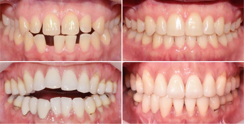 투명치아교정, 발치없이 인비절라인으로 치료 진행 관련 이미지 9