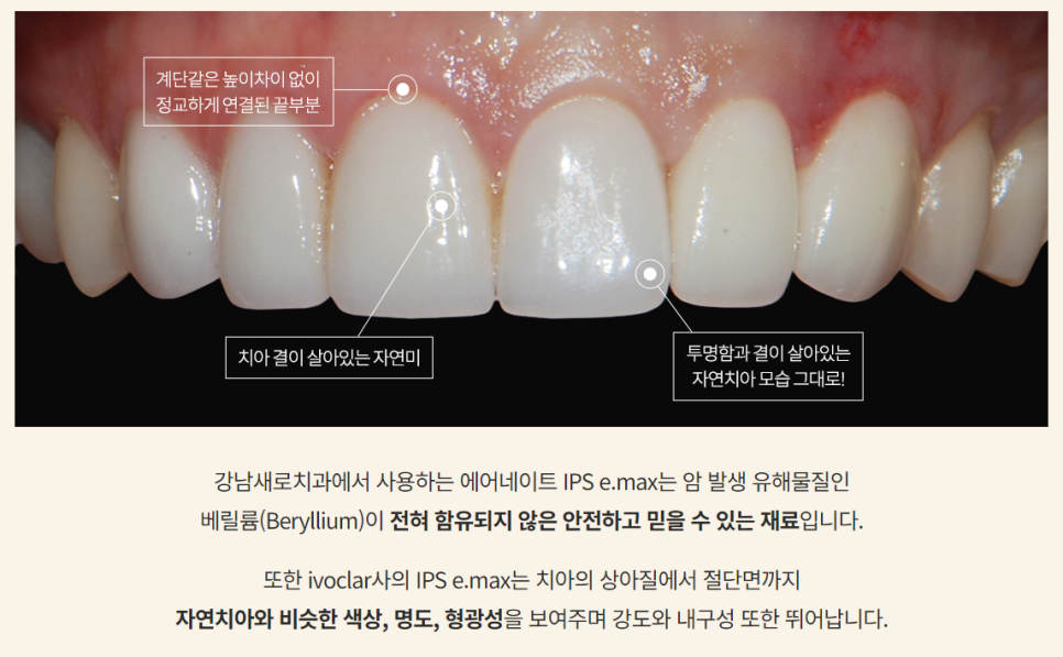 에어네이트의 특별함 (라미네이트 대체 시술) 관련 이미지 8