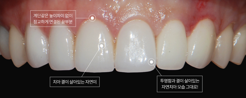 누런 앞니, 치아의 문제를 에어네이트 진료로 해결하려면 관련 이미지 7