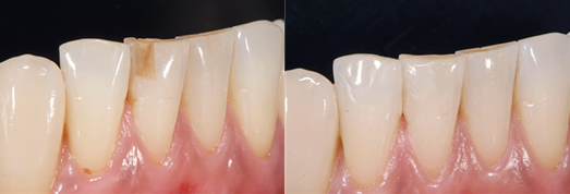 크랙 벌어짐 파절 치아깨짐치료 (레진이란?) 관련 이미지 5