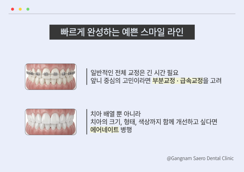 Recommended AirNate Rapid Orthodontic Treatment (Short-Term Cosmetic Dentistry) Before an Important Moment image 2