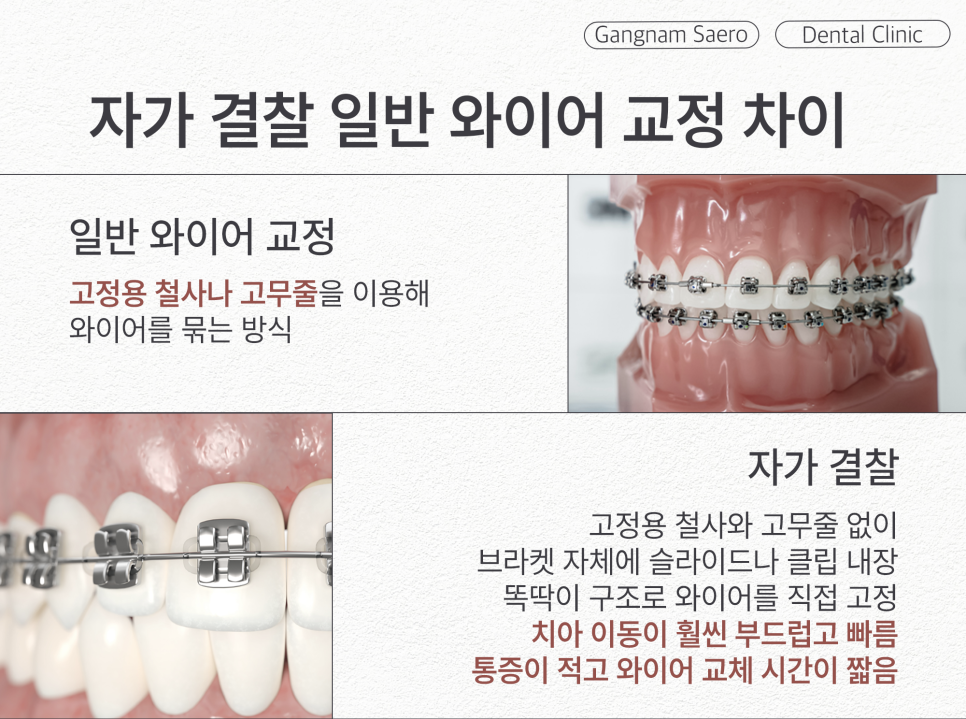 통증과 기간을 줄여주는 프리미엄 교정장치 (자가결찰교정) 관련 이미지 3