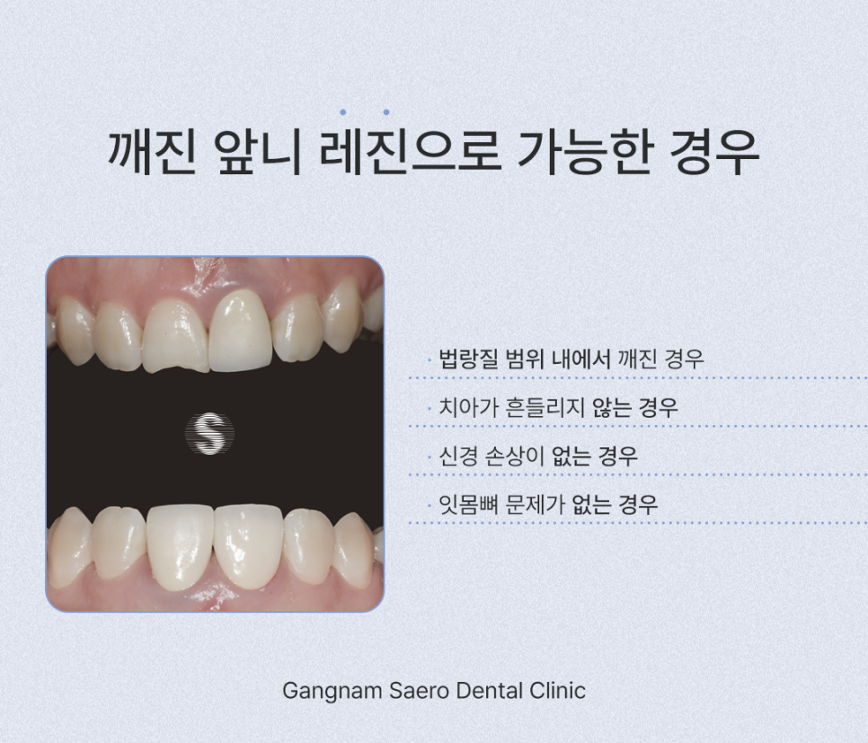 앞니깨졌을때, 깨진앞니 치료하는 여러 가지 방법 레진 / 라미네이트 / 크라운 / 임플란트 관련 이미지 4