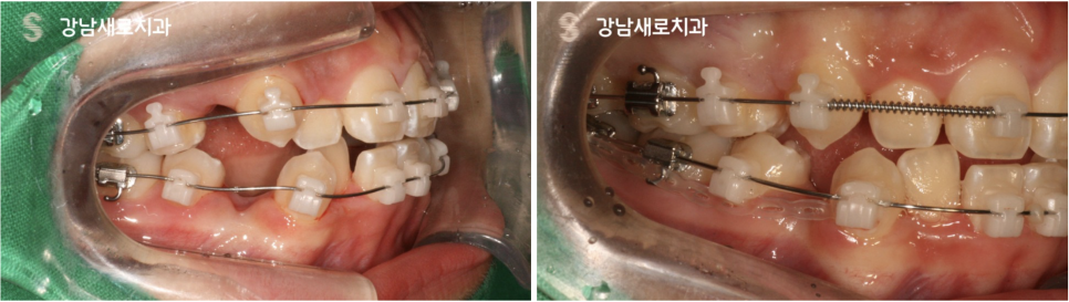 비발치교정치료, 부작용 피하는 방법? 관련 이미지 5