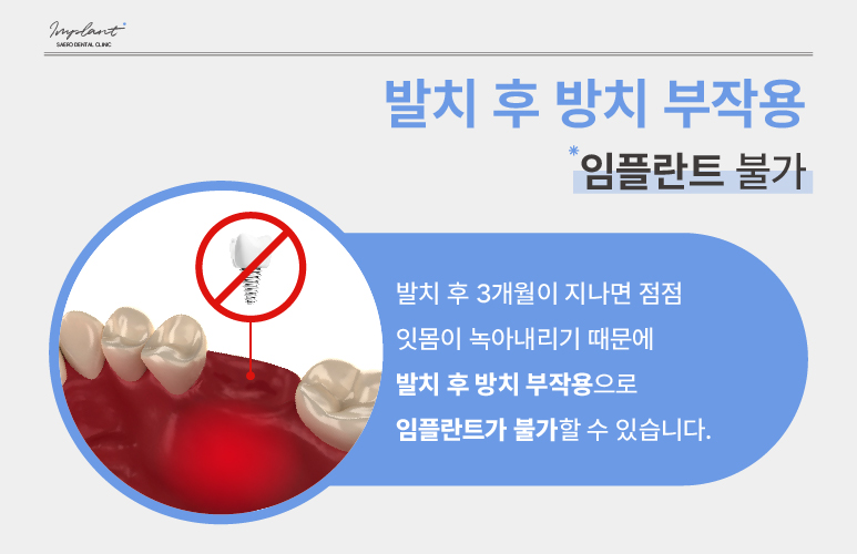 발치 후 방치 부작용 (발치 후 임플란트 해야 하는 이유) [ 강남새로치과 ] 관련 이미지 6