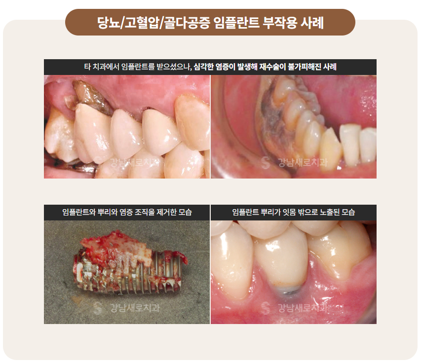 당뇨, 고혈압, 골다공증 임플란트수술 은? (PRF임플란트 자가혈임플란트) 관련 이미지 1