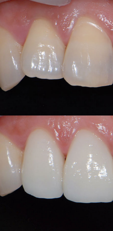 풍자 라미네이트? 치아 삭제 없는 과정으로 관련 이미지 3