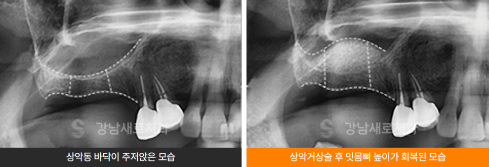 윗니 임플란트 부작용 최소화하려면 (상악동거상술) 관련 이미지 3