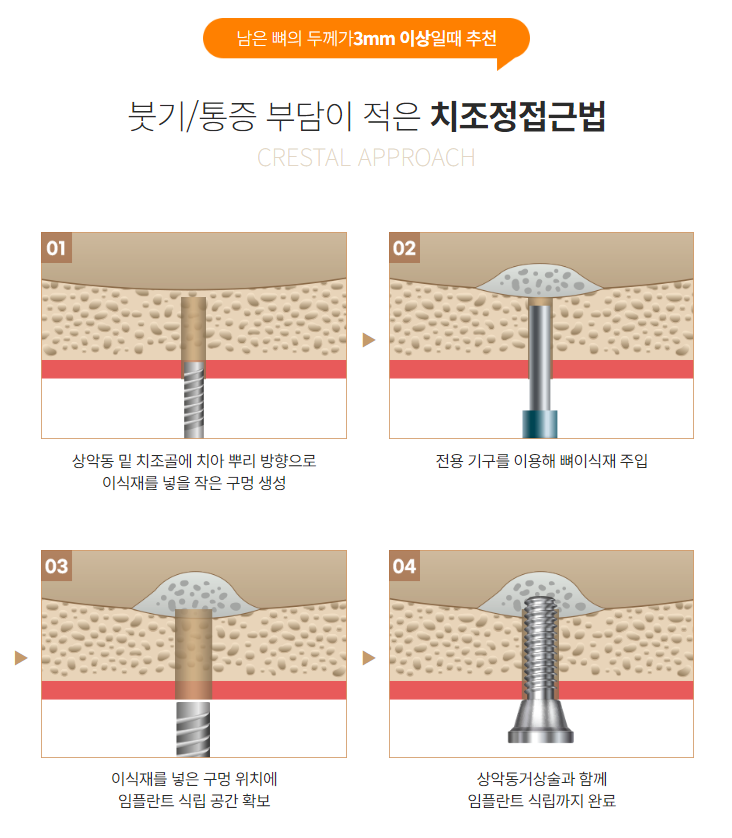 안전한 윗니 임플란트 (상악동거상술) 관련 이미지 1