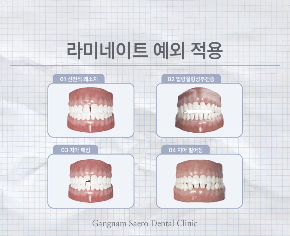 치아 컴플렉스 해결에는 삭제제로라미네이트 에어네이트 (무삭제라미네이트) 관련 이미지 4