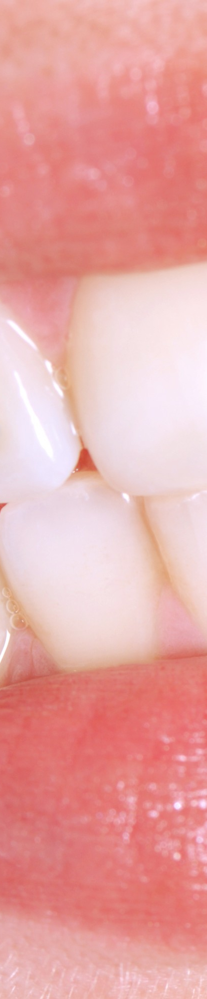 부정교합 교정치료, 비발치로 진행하려면? 관련 이미지 5