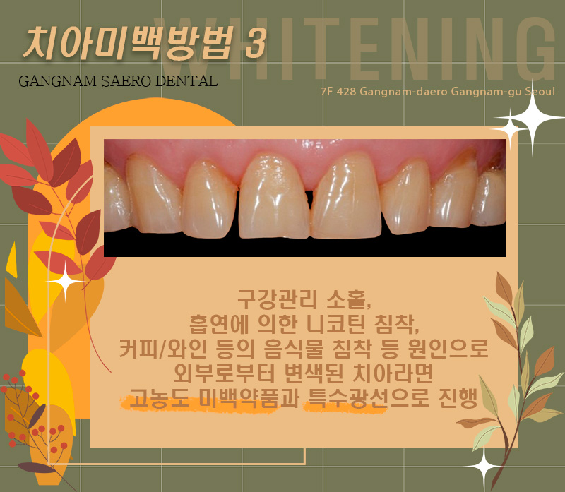 치아미백방법 치아미백비교 치아미백전후 (에어네이트, 전문가미백, 자가미백) 관련 이미지 4