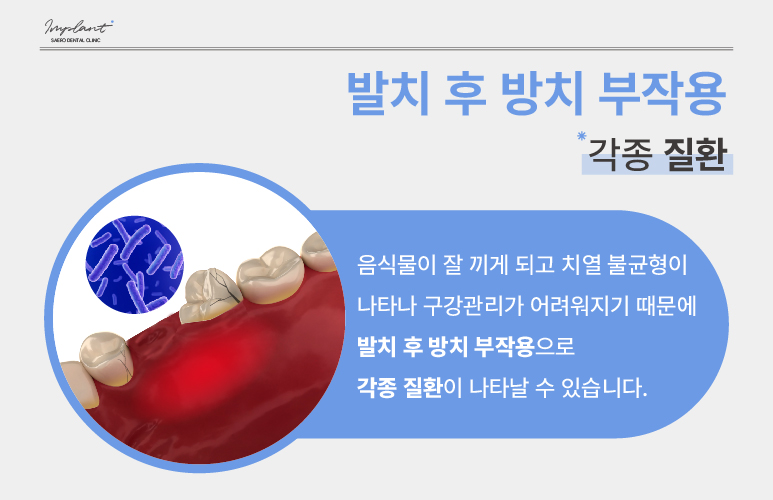 발치 후 임플란트 해야 하는 이유 (임플란트안하면) 관련 이미지 4