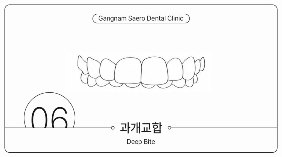 부정교합 개방교합 과개교합 투명교정으로 가능할까요? (주걱턱교정기 돌출입교정기) 관련 이미지 7