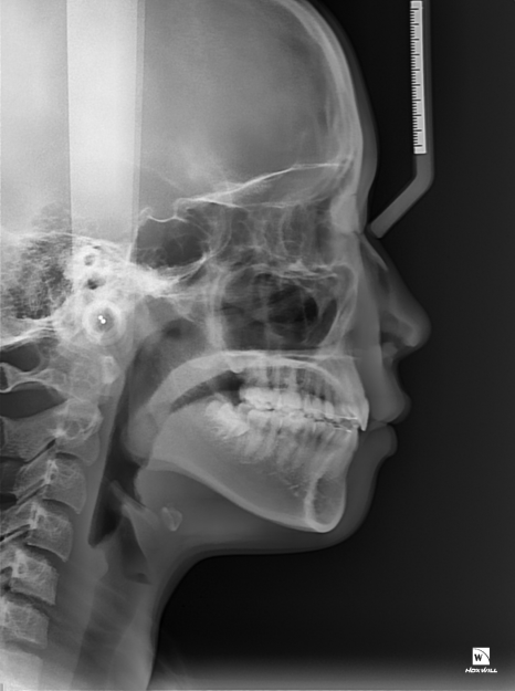 콤플렉스인 뻐드렁니 돌출입 교정으로 개선이 가능할까? 관련 이미지 9