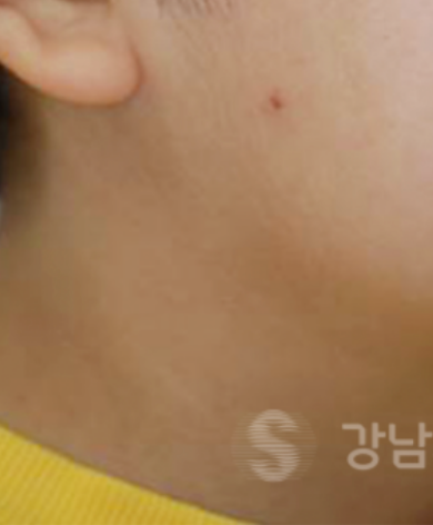 유아 주걱턱교정, 올바른 뼈 성장을 위한 방법 관련 이미지 2