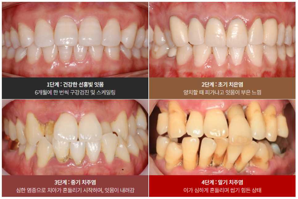 연령별 치아 관리 (임플란트 브릿지 틀니 비교) 관련 이미지 4