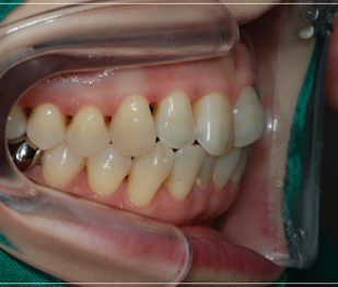 입 안 다물어짐 수술 없이 해결하는 방법 관련 이미지 4