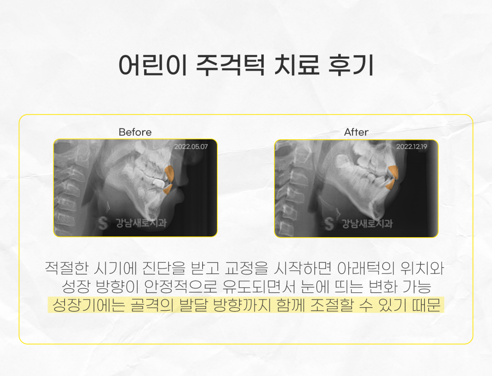 주걱턱 수술 없이 교정하려면 조기 치료가 핵심 (어린이 비수술주걱턱) 관련 이미지 5