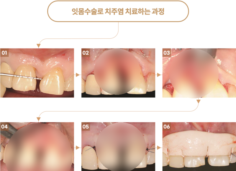 잇몸에서 피가 난다면, 관련 이미지 12