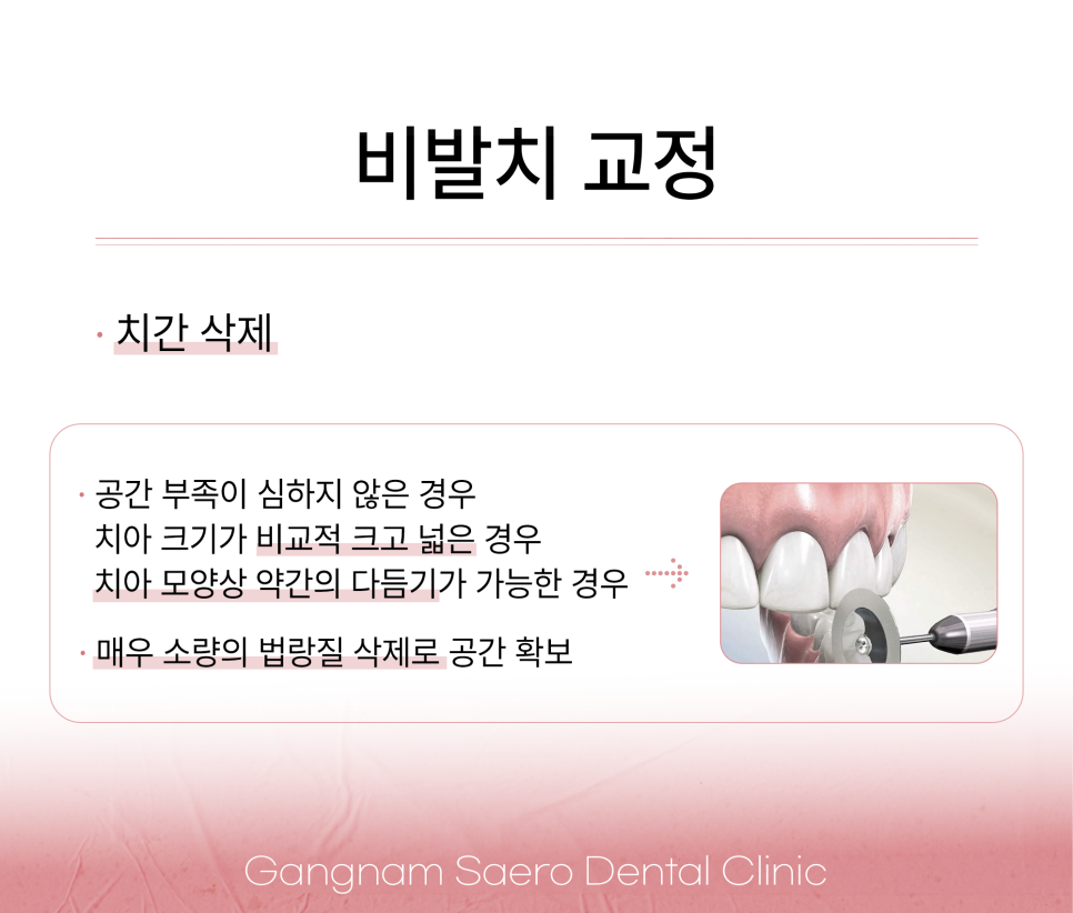 비발치 교정이 다 좋지만은 않은 이유 (발치교정 이유) 관련 이미지 5