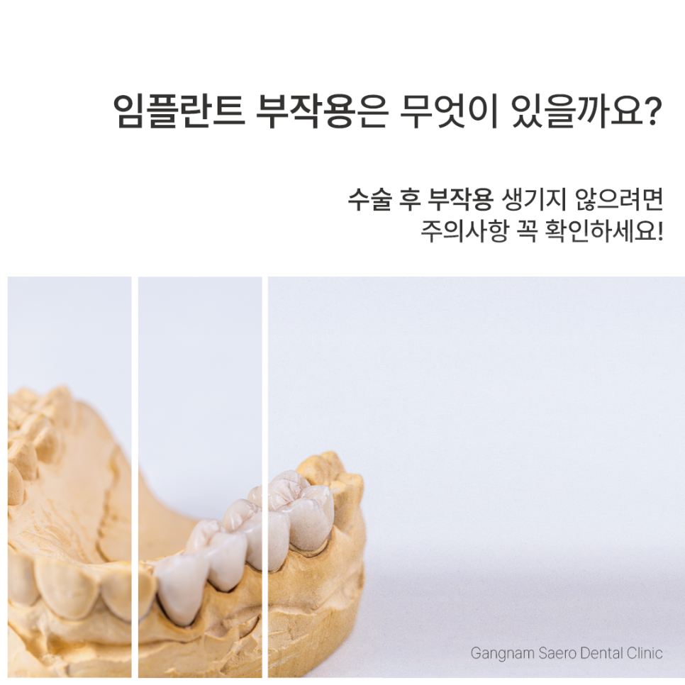 임플란트수술 후 부작용 생기지 않으려면 (임플란트부작용) 관련 이미지 10