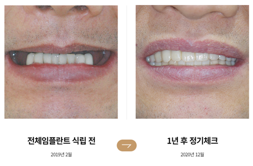 An Efficient Choice When Only a Few Teeth Remain (Full-Mouth Implant Effect) image 4
