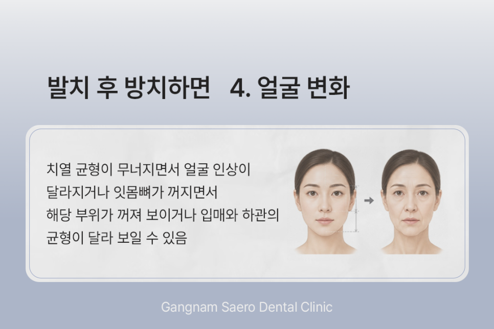What Happens If You Do Not Get an Implant After Tooth Extraction? (Implants After Tooth Extraction) image 6