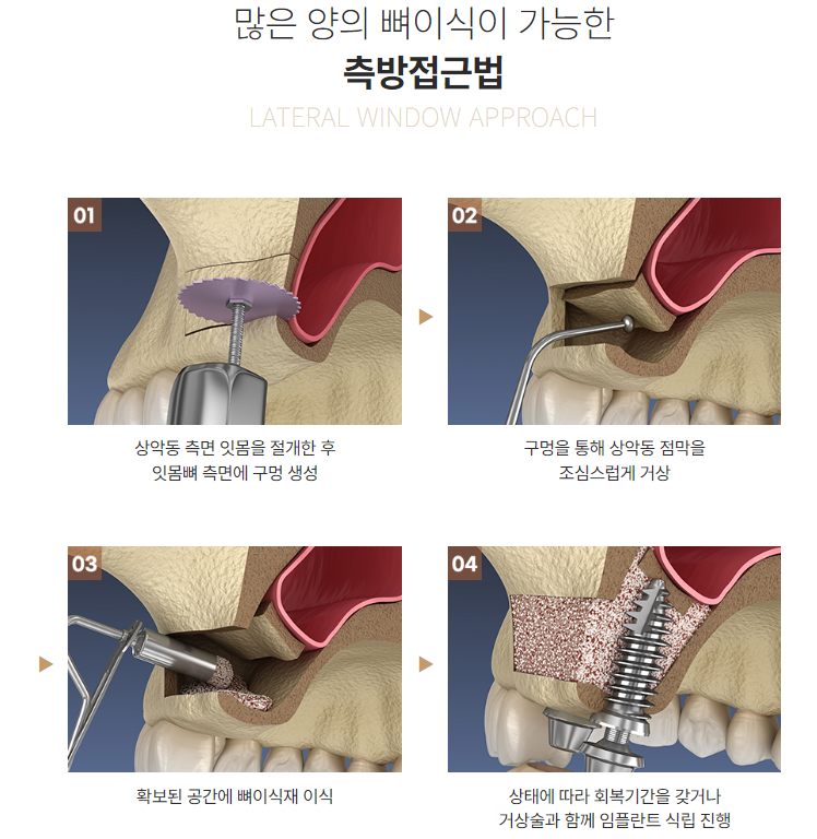 최소식립으로 최대효율 전체임플란트 (65세임플란트) 관련 이미지 3