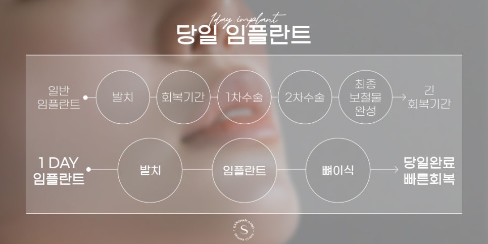 최대 6개월 기간 단축 20대 30대 임플란트 (당일임플란트) 관련 이미지 3