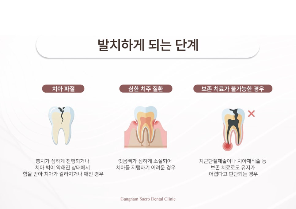 What If Your Dentist Says a Severely Decayed Tooth Needs to Be Extracted? (Reasons for Extraction Due to Tooth Decay) image 5