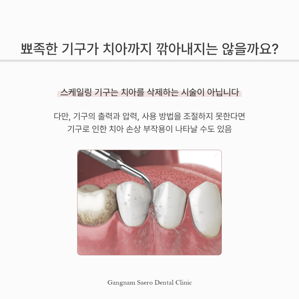 스케일링 후 이가 시리고 벌어졌다? 스케일링부작용 오해와 진실 관련 이미지 2