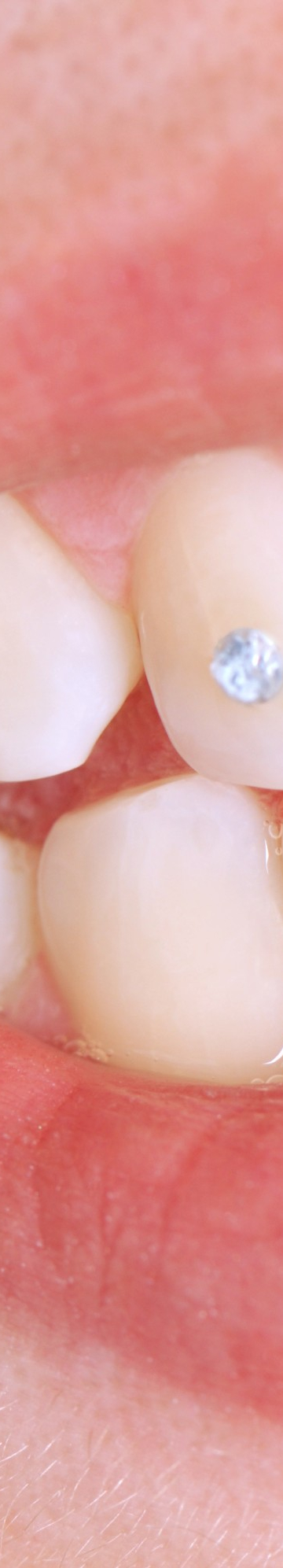 부정교합 교정치료, 비발치로 진행하려면? 관련 이미지 4