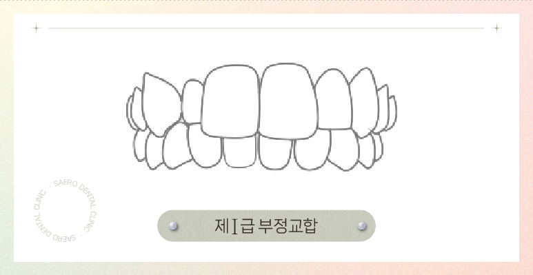 부정교합 투명교정 (1~3급 부정교합 개방교합 과개교합 인비절라인 나노라이너) [ 강남새로치과 ] 관련 이미지 4