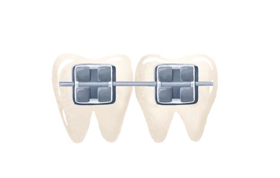 교정고무줄통증이 발생하는 이유와 진료 후 관리 방법 관련 이미지 4