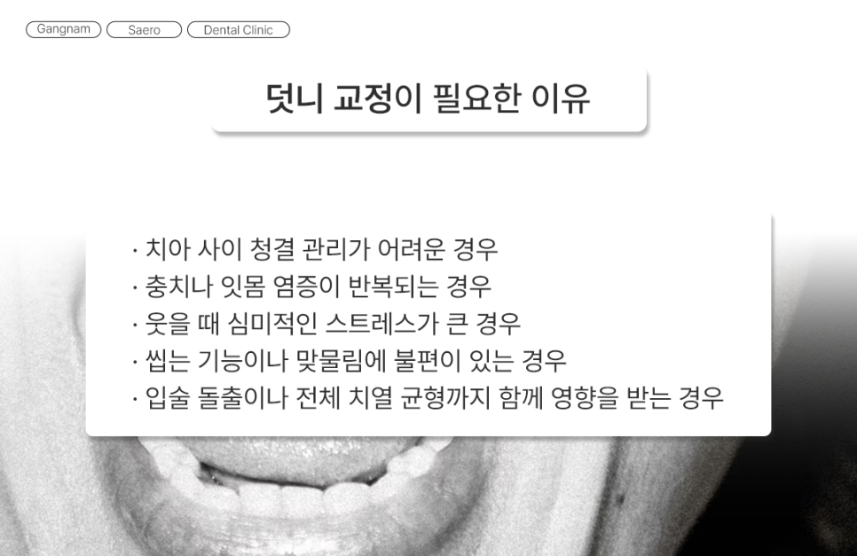 삐뚤어진 치아를 가지런하게 기능과 심미 회복 (덧니교정) 관련 이미지 4