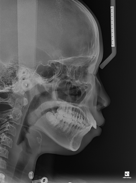 콤플렉스인 뻐드렁니 돌출입 교정으로 개선이 가능할까? 관련 이미지 8