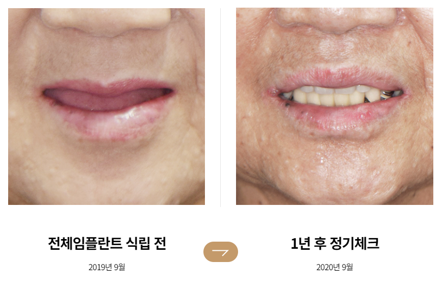 65세이상임플란트 (전체임플란트전후) 관련 이미지 2