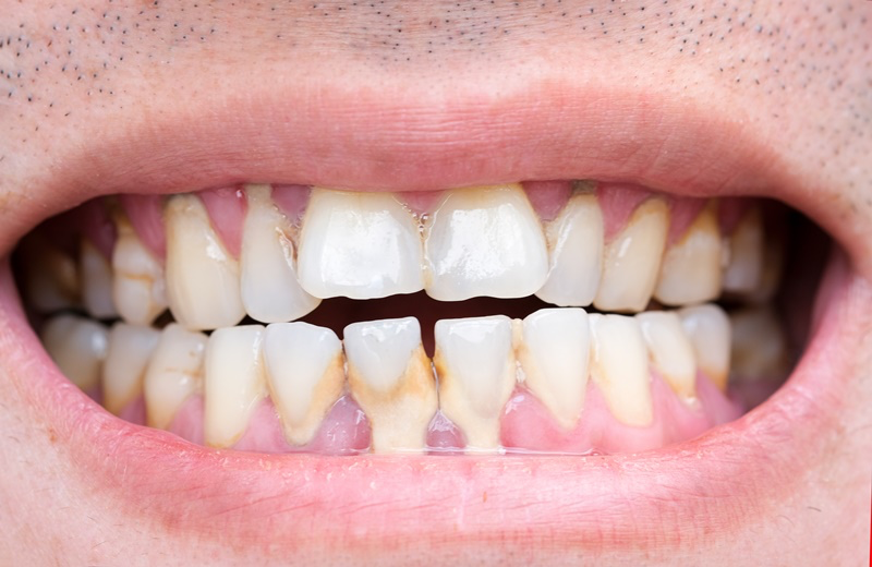 잇몸에서 피가 난다면, 관련 이미지 6