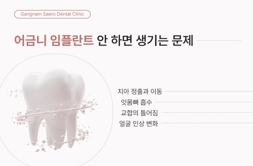 어금니 발치 후 임플란트 안 하면 어떻게 될까요? (어금니임플란트) 관련 이미지 5