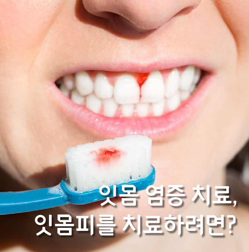 강남역잇몸염증치료, 잇몸피가 나는 원인의 치료방법? 관련 이미지 4